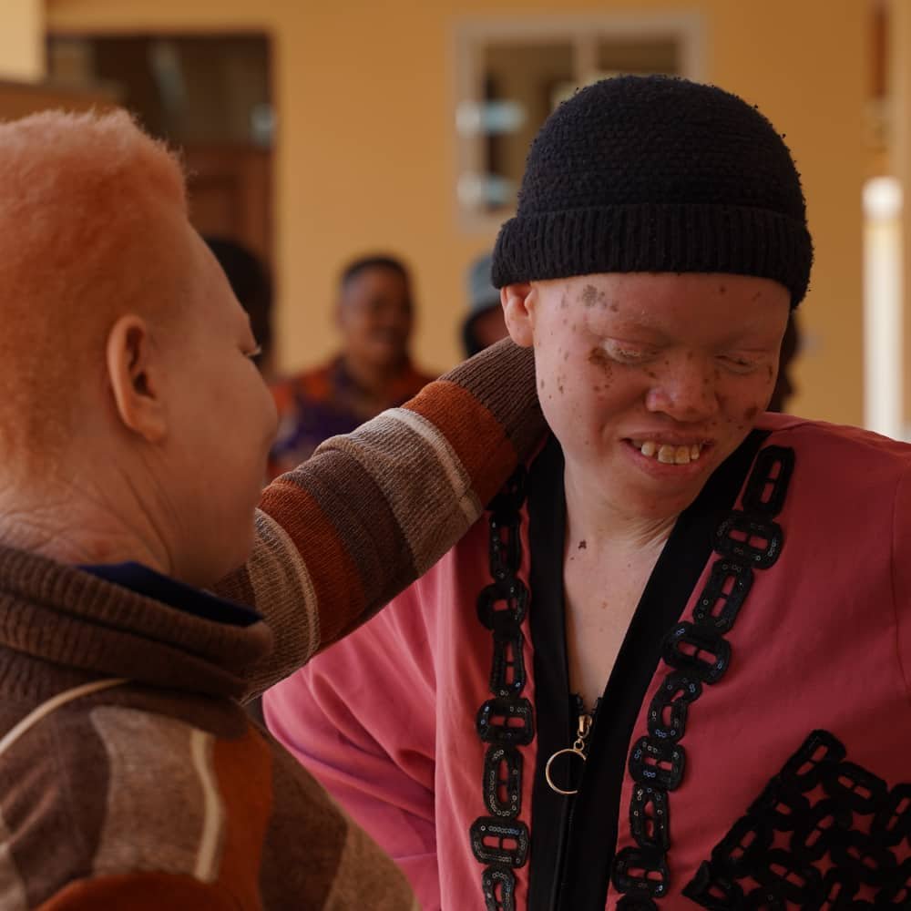 A person with albinism is smiling while looking at the floor