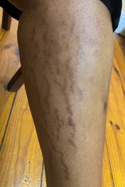 Permanent stretch marks on a lady's leg due to topical steroid cream abuse