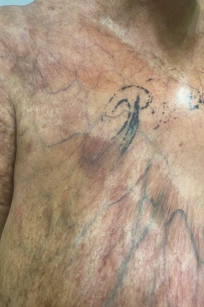 Skin thinning and easy bruising on a lady's chest from long-term inappropriate use of topical steroids for skin bleaching