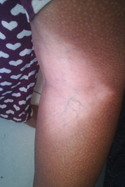Telangiectasia (sometimes referred to as spider veins) on a woman's leg from long-term inappropriate use of topical steroids for skin bleaching